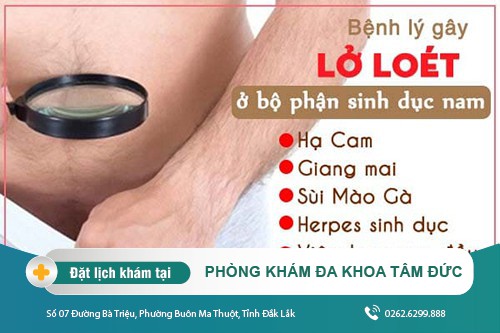 Chữa viêm vùng kín nam tại Đắk Lắk - Lý do bị viêm loét bộ phận sinh dục nam là gì?