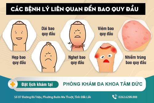 Tổng quan về các bệnh lý liên quan đến bao quy đầu