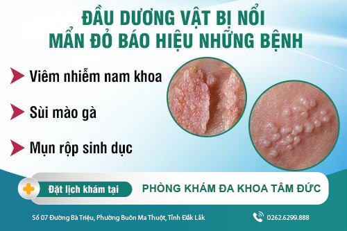 Đầu dương vật bị nổi mẩn đỏ báo hiệu điều gì? Các bệnh lý liên quan