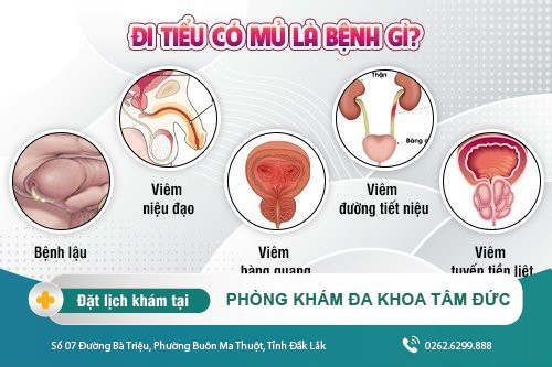 Đi tiểu có mủ là bệnh gì và cách điều trị