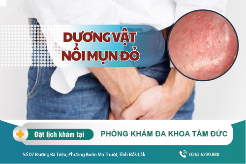 Nguyên nhân khiến đầu dương vật nổi mụn đỏ không ngứa? Đâu là cách điều trị hiệu quả?