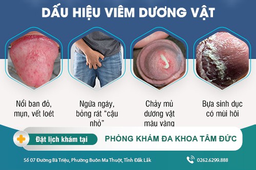 Chữa viêm dương vật tại Đắk Lắk - Viêm dương vật có dấu hiệu gì?