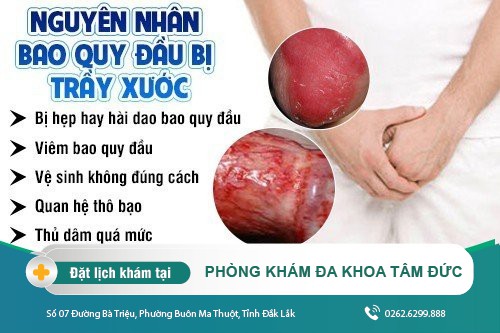 Trầy xước bao quy đầu - nguy cơ mắc bệnh lý nếu lơ là
