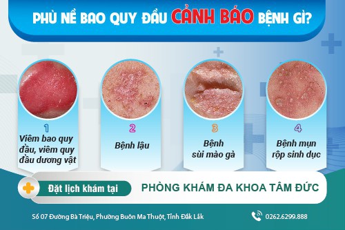 Phù nề bao quy đầu: Dấu hiệu của bệnh gì? Cách điều trị hiệu quả hiện nay