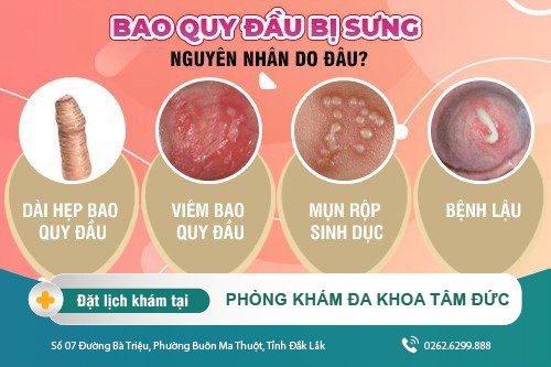 Sưng bao quy đầu có nguy hiểm không? Chi phí điều trị hết bao nhiêu?
