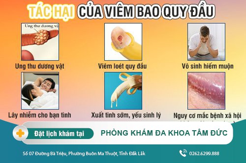 Những điều cần biết về viêm bao quy đâu