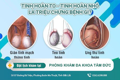 Tinh hoàn 1 bên to 1 bên nhỏ: Nguyên nhân bệnh lý và phương án điều trị