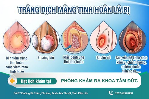Tinh hoàn có nước - Tràn dịch là biểu hiện bệnh lý gì ? Nguyên nhân và cách điều trị