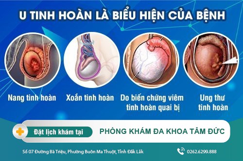 U tinh hoàn là biểu hiện của bệnh gì?